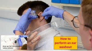 How to Perform an Ear Washout irrigation  ENTOtolaryngology Skills [upl. by Ellehcirt]