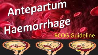 Antepartum Haemorrhage  RCOG Guideline [upl. by Kazue34]