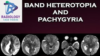 Band heterotopia and Pachygyria [upl. by Carolee]