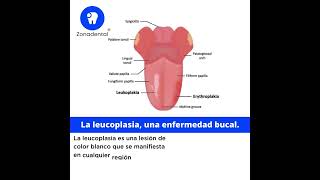 La leucoplasia una enfermedad bucal [upl. by Aym810]