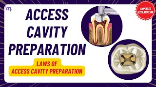 Access Cavity Preparation  Laws of ACP  Clinical tests  Procedure  Endodontics  Animated [upl. by Tailor]