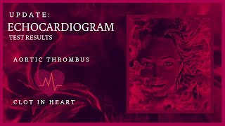 Echocardiogram Results for Blood Clot in my Heart Right Atrial Thrombus MPN Polycythemia Vera BCAM [upl. by Blen]