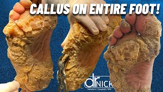 SHAVING CALLUS ON ENTIRE SOLE OF FOOT Dr Nick Campitelli Foot amp Ankle Surgeon [upl. by Isnam]