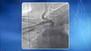 Chapter 14 TRA for addressing Subclavian amp Innominate Artery Lesions [upl. by Aicenek]