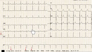 ECG de A à Z  exercice 1  correction [upl. by Aivekahs]