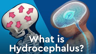 What is Hydrocephalus and Why Does Fluid Build Up in the Brain [upl. by Llennol573]