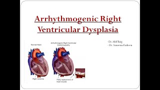 Arrhythmogenic Right Ventricular Dysplasia Dr Akif Baig Dr Sameena Farheen [upl. by Hofmann]