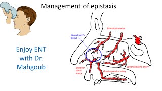 23 Management of Epistaxis [upl. by Spiros]