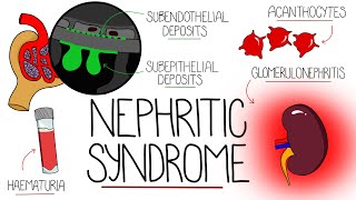 Understanding Nephritic Syndrome With Pathology Made Easy [upl. by Colb]