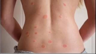 Pityriasis Rosea [upl. by Dier]