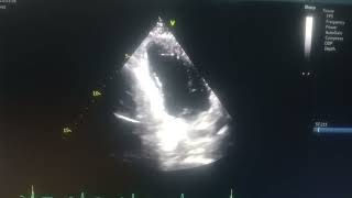 akinetic septum hypokinetic mid apical anterior and inferior wall moderate Lv [upl. by Lidstone]