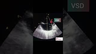 AV canal defect  ASD  VSD  congenital heart disease [upl. by Esinrahc]