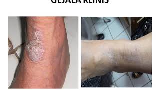 NEURODERMATITIS  Materi Kedokteran  Dermatologi [upl. by Vidal]