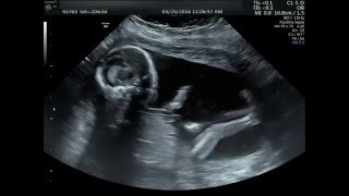 20 week Ultrasound Its a boy [upl. by Nohtan694]