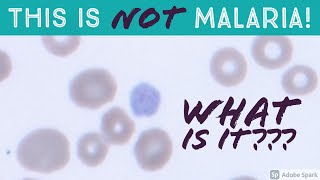 This is NOT Malaria What is it An Important Mimic of Plasmodium vivax Gametocyte on Blood Smear [upl. by Barbaresi]