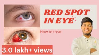 Blood spot in eye reasons How to treat blood spot in eye  Subconjunctival haemorrhage [upl. by Dittman]