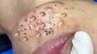 Big Cystic Acne Blackheads Extraction Blackheads amp Milia Whiteheads Removal Pimple Popping  5612 [upl. by Resiak174]