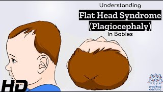 Flat Head Syndrome Explained Causes Symptoms and Solutions [upl. by Lasyrc]