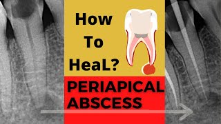 Case of PERIAPICAL ABSCESS Dr Sunil kumar Dental ji [upl. by Padget409]