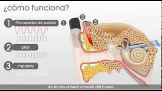 SH Medical Group  Como funciona el sistema auditivo Cochlear Baha [upl. by Alomeda]