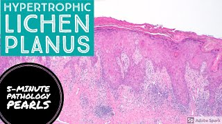 Hypertrophic Lichen Planus 5Minute Pathology Pearls [upl. by Harman]