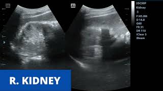 Acute Pyelonephritis  Ultrasound Case [upl. by Anabel]