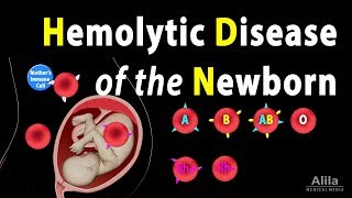 Hemolytic Disease of the Newborn HDN Animation [upl. by Ainnos448]