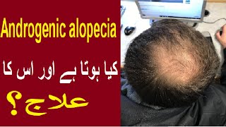 Androgenic alopecia  androgenic alopecia hair regrowth  androgenic alopecia treatment  drzunair [upl. by Neelhtakyram]