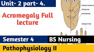 Acromegaly  Growth Hormone Signs amp Symptoms Diagnosis Treatment  Pathophysiology 2 in Urdu [upl. by Paderna]