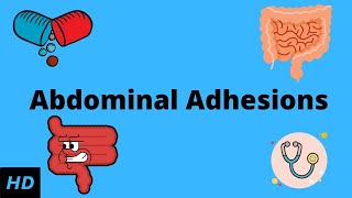 Abdominal Adhesions Causes Signs and Symptoms Diagnosis and Treatment [upl. by Broderic]