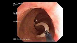 Ascaridosis on colonoscopy Аскариды при колоноскопии [upl. by Kauppi926]