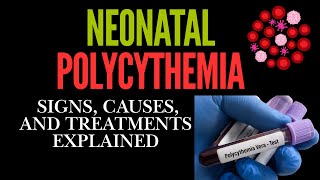 Neonatal Polycythemia Signs Causes and Treatments Explained [upl. by Alexine]