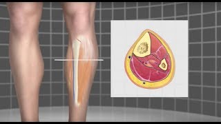 Runners Compartment Syndrome  Mayo Clinic [upl. by Haerdna]