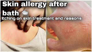 5 reason of skin itching after showerTreatment and symptoms of skin allergy Is itching dangerous [upl. by Uhthna]