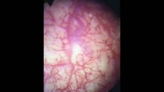 Cystoscopy of Interstitial Cystitis [upl. by Felicity808]