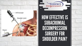 How effective is Subacromial decompression surgery for shoulder pain [upl. by Atteiram340]