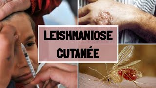 LA LEISHMANIOSE CUTANNÉ  CAUSES  SYPMTOMES  COMPLICATIONS  TRAITEMENT [upl. by Gerlac]