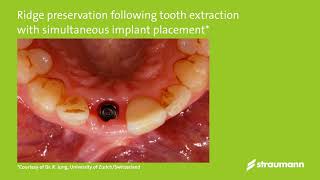 Clinical use of Straumann® BoneCeramic Dr Jung [upl. by Yecaj]