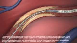 Abbotts Absorb Bioresorbable Vascular Scaffold [upl. by Eadahc]