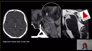 Calcificações intracranianas sem significado clínico provavelmente  Parte 2 [upl. by Oigaib170]