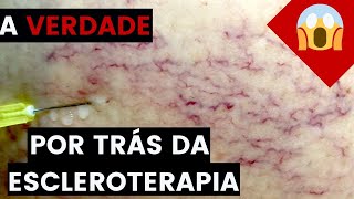 A VERDADE por trás da ESCLEROTERAPIA aplicação de VARIZES Não faça se você NÃO souber isso [upl. by Aneerhs783]