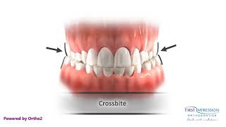 Correcting Posterior Crossbites [upl. by Ban]