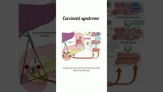 Carcinoid Syndrome kattrucate medicalreels syndrome symptoms diarrhoea vomiting heartfailure [upl. by Riccio]