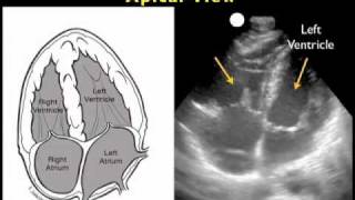 How to Cardiac Ultrasound  Apical View Case Study [upl. by Nosyaj87]