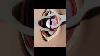 Tracheostomy procedure 3D animation tracheostomy shorts short usa health 3danimation anatomy [upl. by Marlea]