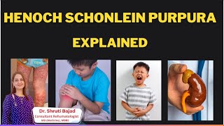 HenochSchonlein Purpura  IGA Vasculitis  Dr Shruti Bajad vasculitis arthritis [upl. by Gleason]