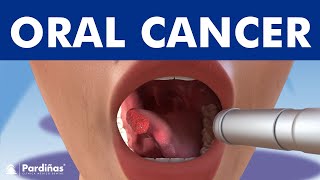 ORAL CANCER and tumors in the mouth lips and tongue © [upl. by Yeoj]