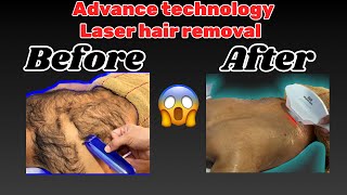 Back and shoulders laser hair removal 😱advance technology  amazing tutorial  by MJ [upl. by Gene126]