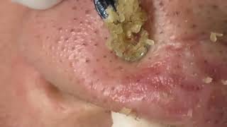 Acne 58  Blackheads on the nose like lovely pearls [upl. by Alanah712]