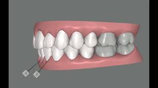 Diastema Closing gap between front teeth with Invisalign [upl. by Froemming]